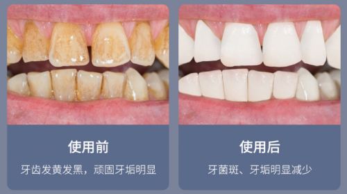 告別刷牙盲區，現代口腔護理新選擇 為何它能解決你的深層困擾